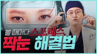 [VN TV] #짝눈교정 가능? 불가능?? #성형외과전문의 #김태훈 원장
