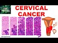Squamous Intraepithelial Lesion CANCER CERVIX