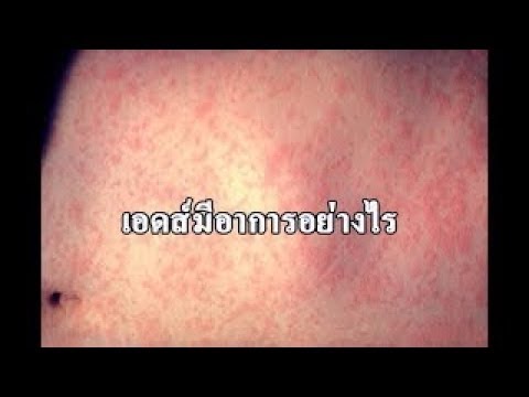 กว่าที่จะรักษากลากแห้งบนส้นเท้าของเขา การรักษาแพทย์ผิวหนังของโรคสะเก็ดเงิน