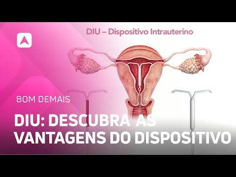 DIU: descubra as vantagens do dispositivo intrauterino como método anticoncepcional