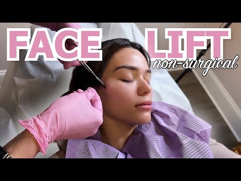 NON SURGICAL FACELIFT WITH PDO THREADS!! 