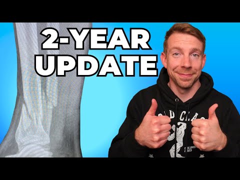 Tib/Fib Fracture 2-Year Recovery Update