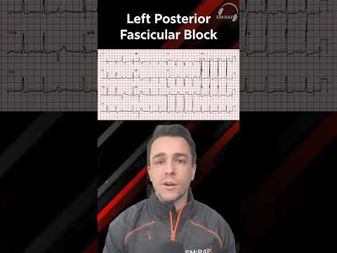 How to Spot a Fascicular Block on ECG