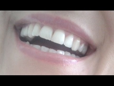 Ammaccature hypostases sotto occhi e reni Pelle di faccia flaccida dopo 25