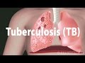 Tuberculosis (TB): Progression of the Disease, Latent and Active Infections.