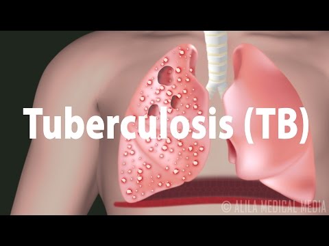 Tuberculosis tb progression of the disease latent and active infections