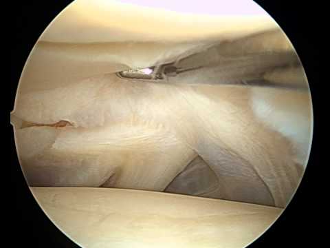 Unguento per il trattamento del giunto in gravidanza Trattamento sciatica lombare acuta