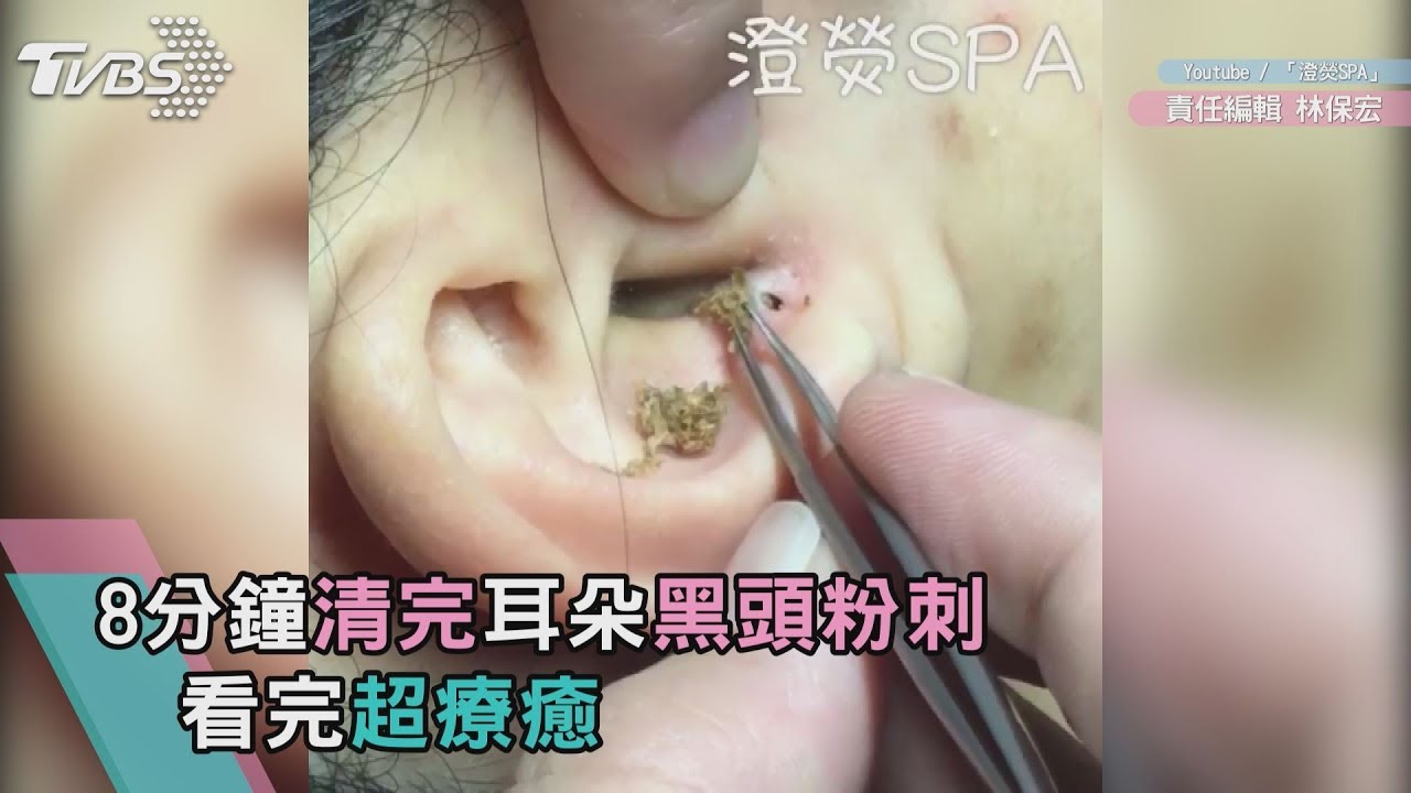 中壢清5洞「黑頭粉刺」影片超療癒 夯到國外去