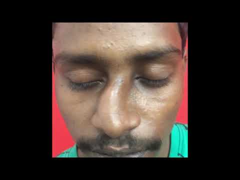 Ethnic Septoplasty and Rhinoplasty - by Dr Sunil Richardson