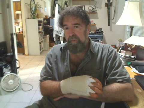 Trigger Finger Surgery Post-OP, aftermath - explained by Mickey Stein (Trigger Finger Part 2)