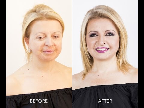 Il pigmentary nota su un mento di fotografia Se è possibile asciugare con perossido didrogeno una faccia da pigmentary nota in