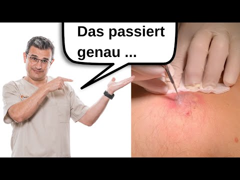Was tun bei einer infizierten Talgzyste? Abwarten oder aufschneiden?