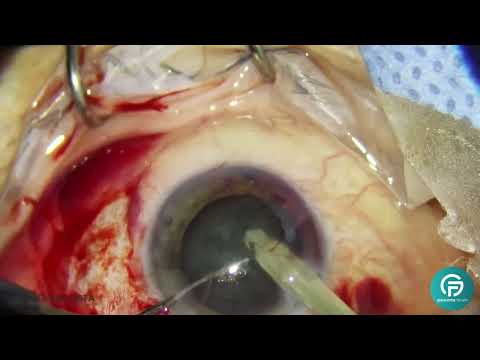 Video educativo de Glaucoma Forum en YouTube