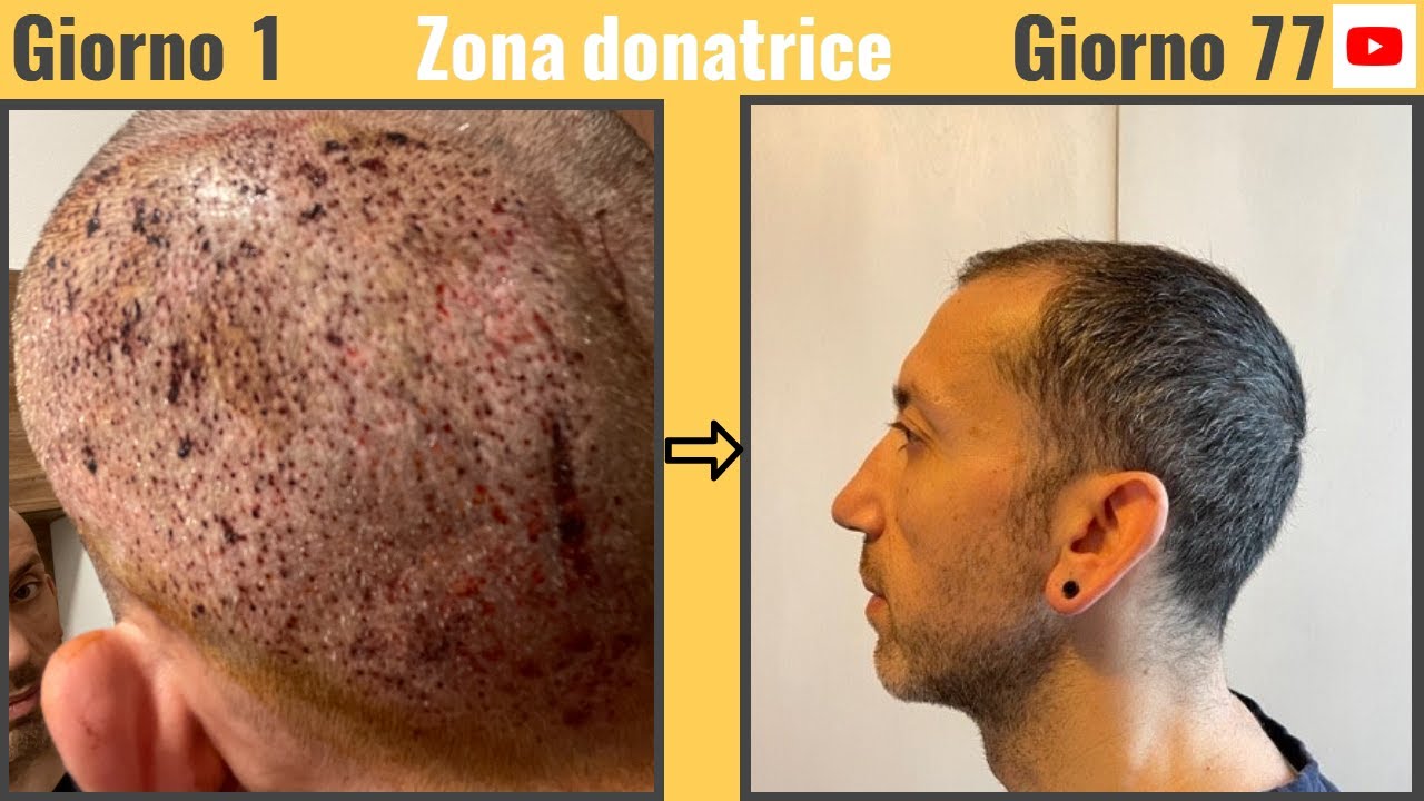 Trapianto capelli. Aggiornamento 77 giorni post trapianto.
