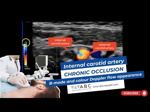 Internal carotid artery chronic occlusion: B-mode and colour Doppler flow appearance.Carotid Doppler