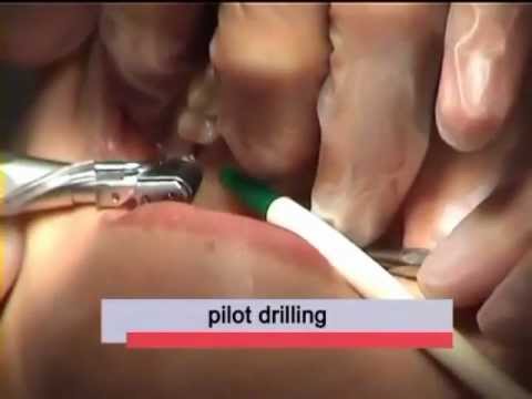 Dr Cziner Sofortimplantation Ungarn - www.sofortimplantate.net - Sofort belastbare Zahnimplantate