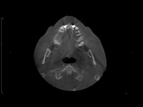 2 minute video - Tonsiliths on CBCT