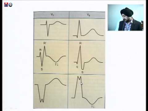 Bundle branch block and its significance - Dr. Jitender Singh Makkar 28.09.2013 03