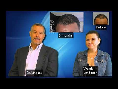 5 month update on 1000 FUE's in african american frontal hairline by Dr. Lindsey | McLean | Virginia thumbnail