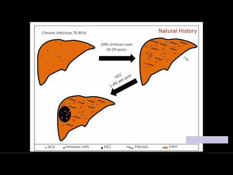 Updates in Hepatocellular Carcinoma