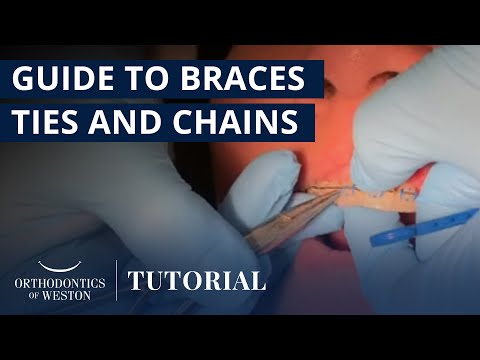 How to Use Elastic Ties, Power Chains, and Steel Ties | Orthodontics of Weston - Dr. Marissa Cooper