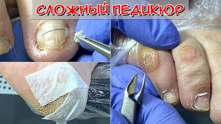 Сухая мозоль на мизинце ноги / Трещины на пятках