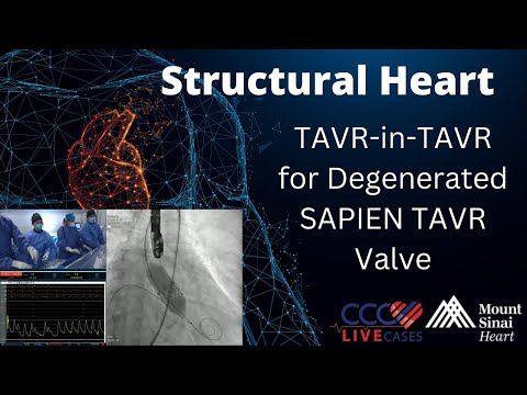 TAVR-in-TAVR for Degenerated SAPIEN TAVR Valve
