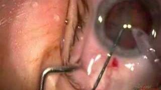 Cataract Extraction with Implant