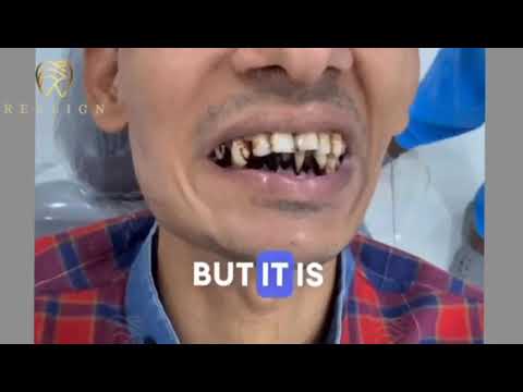 Protect Your Smile: Say No to Tobacco