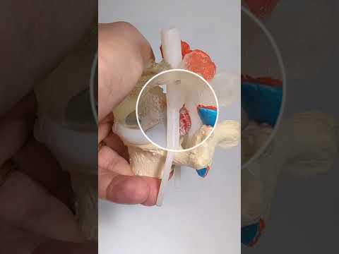 L5 Nerve Pinching from Disc Herniation #anatomy #lumbar