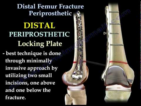 Distal Femur Fracture Periprosthetic - Everything You Need To Know - Dr. Nabil Ebraheim