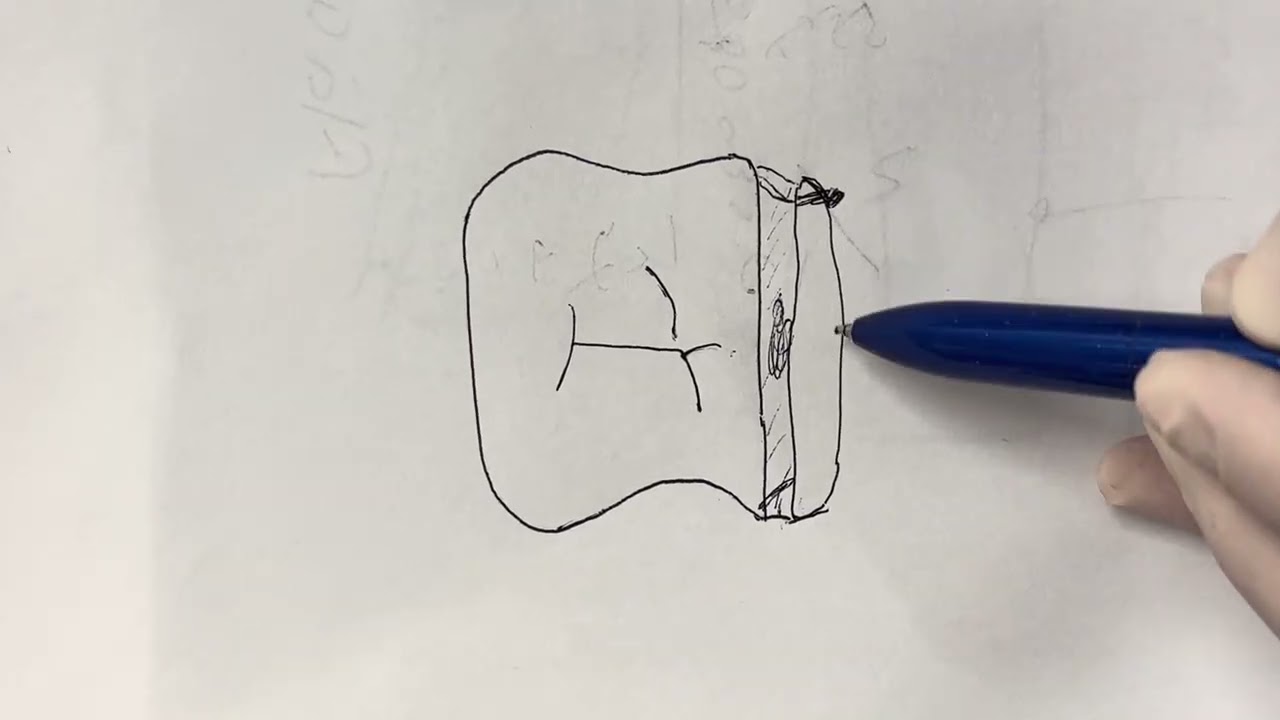 マンツーマンセミナー：左上6番支台歯形成(5/14)スライスが切れきれなかった時の対応。咬合面観からの解説