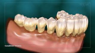 Periodontitis - Gum Disease