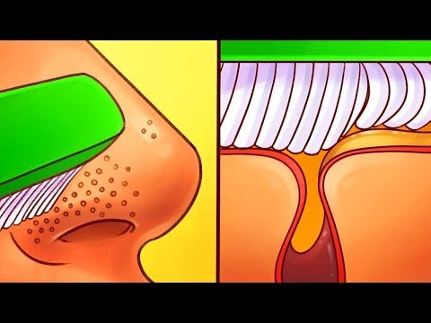 Dopo che la gravidanza pigmentary i posti non è scomparsa Togliere lentiggini a mano