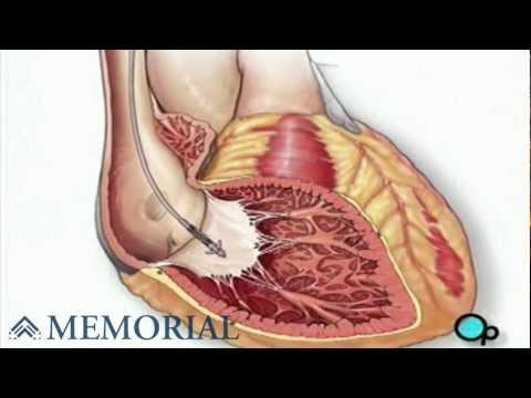 Permanent Pacemaker Implant