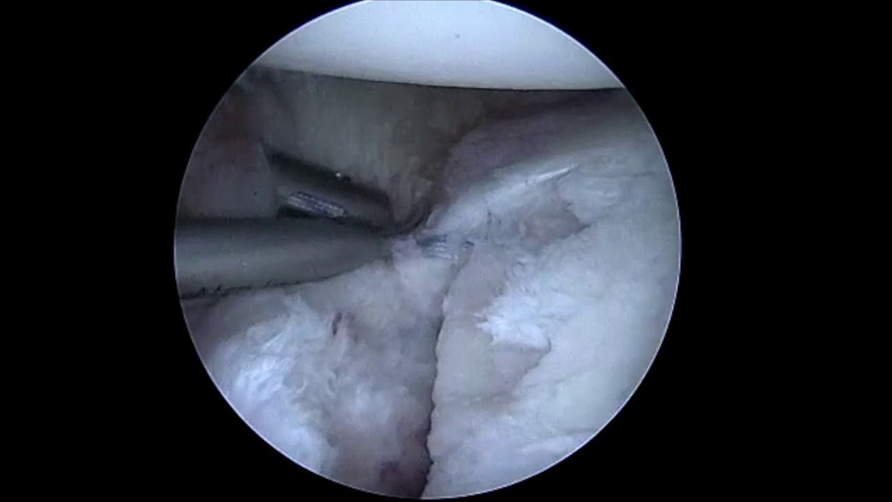 Dr. Garcia demonstrates his advanced technique for arthroscopic glenoid fracture fixation ...