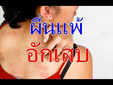 ราคาครีมโรคสะเก็ดเงิน โรคสะเก็ดเงินสิวหนอง