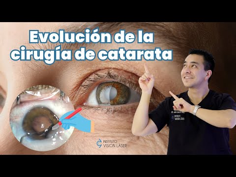 Evolución de la cirugía de catarata