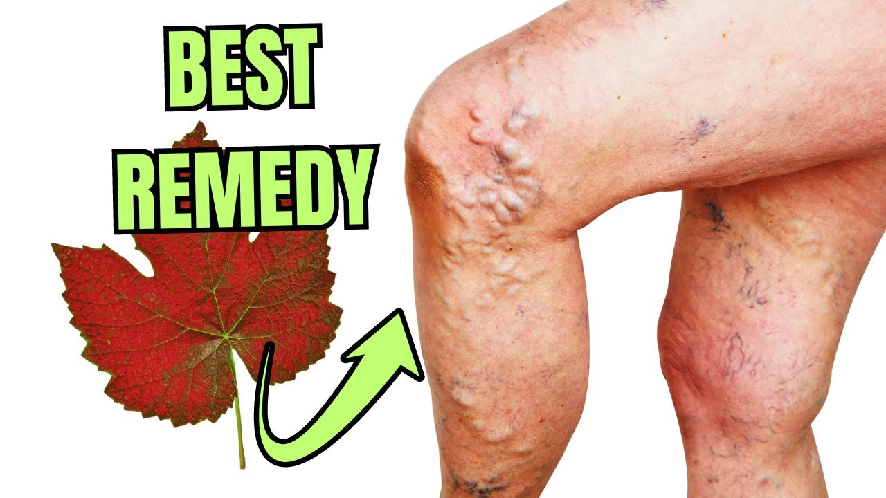 What Surgeons Don't Tell You: A Simple Fix for Venous Insufficiency!