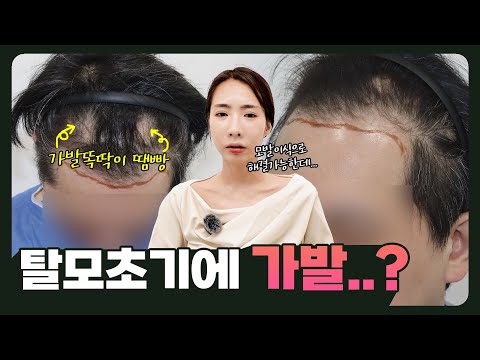 [EN][JP]모발이식 VS 가발착용, 탈모 초기 고민이라면 이 영상 꼭 보세요!