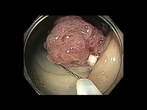 Colonoscopy: Large Cecal Polyp Resection - One or Two Appendicular orifices?