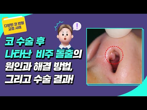 [ 코 변형 쿄정 사례] 코 수술 후 나타난 "비주 돌출"의 이유와 해결 방법! ✅