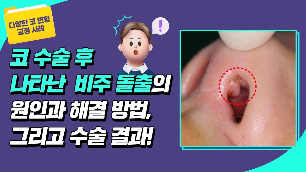[ 코 변형 쿄정 사례] 코 수술 후 나타난 "비주 돌출"의 이유와 해결 방법! ✅ 썸네일