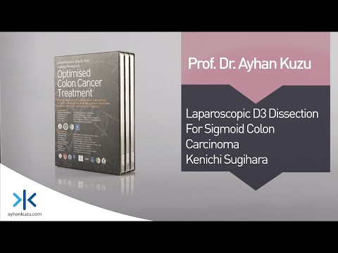 2.3.3. Laparoscopic D3 dissection for Sigmoid Colon Cancer - Kenichi Sugihara