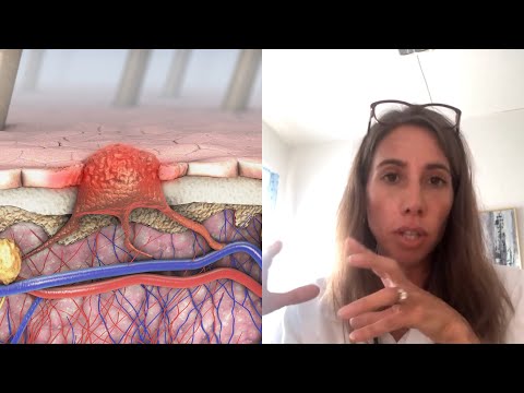 Pasienter med føflekkreft uten spredning har like dårlig overlevelse som de med spredning