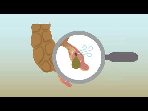 Identifying acute appendicitis on abdominal CT