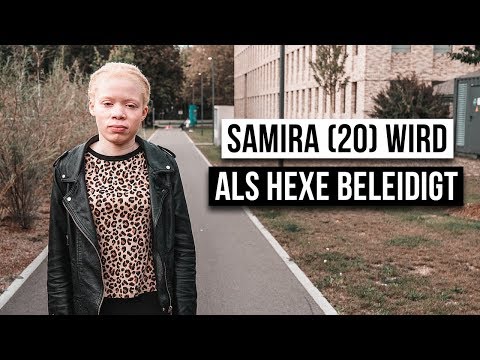 What is it like to be an albino?