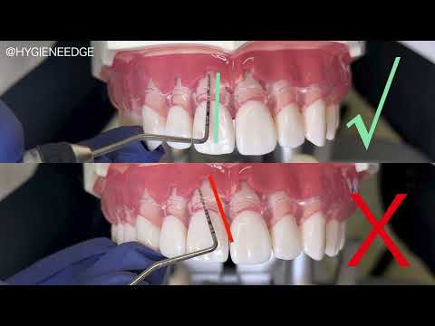 All Things Periodontal Probing with Kilgore International
