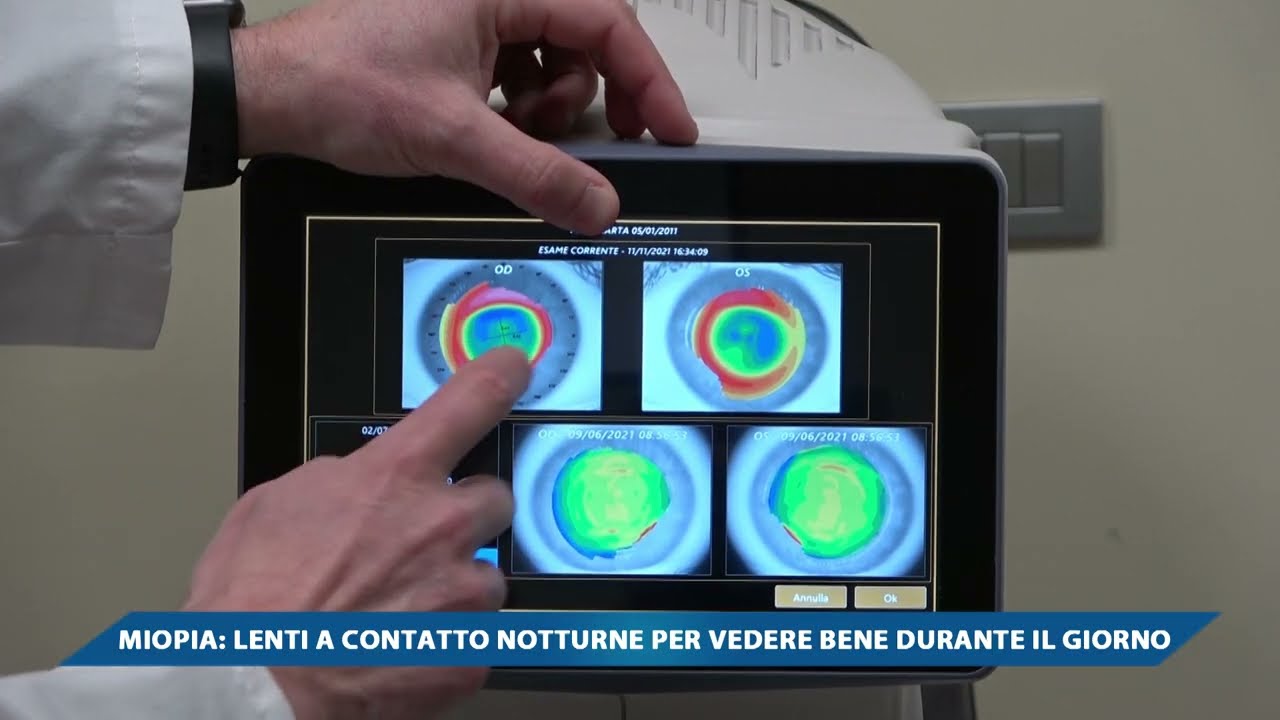 Watch Now MIOPIA, LENTI A CONTATTO NOTTURNE PER VEDERE BENE DURANTE IL GIORNO MIOPIA, LENTI A CONTATTO NOTTURNE PER VEDERE BENE DURANTE IL GIORNO