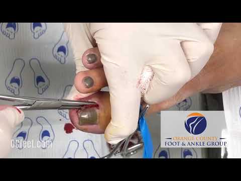 Graphic Ingrown Toenail Video